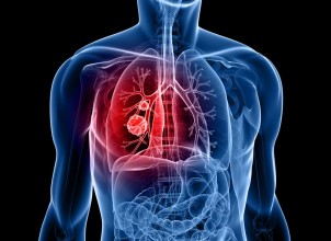 Akciğer Kanserinin Belirtileri ve Tedavisi