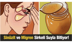 Sinüzit Ve Migren Sirkeli Suyla En Fazla 15 Günde Bitiyor !